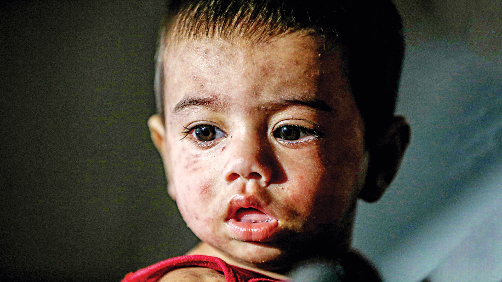 ৫৬ জেলায় ছড়িয়েছে হাম, ২১ উপজেলা উচ্চ ঝুঁকিপূর্ণ