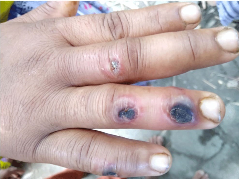 নাটোরে অ্যানথ্রাক্স আতঙ্ক, আইইডিসিআরের বিশেষজ্ঞ দল যাচ্ছে আজ