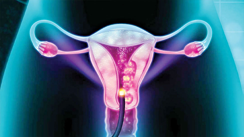 জরায়ুমুখ ক্যানসার কী, প্রতিরোধে যা করবেন