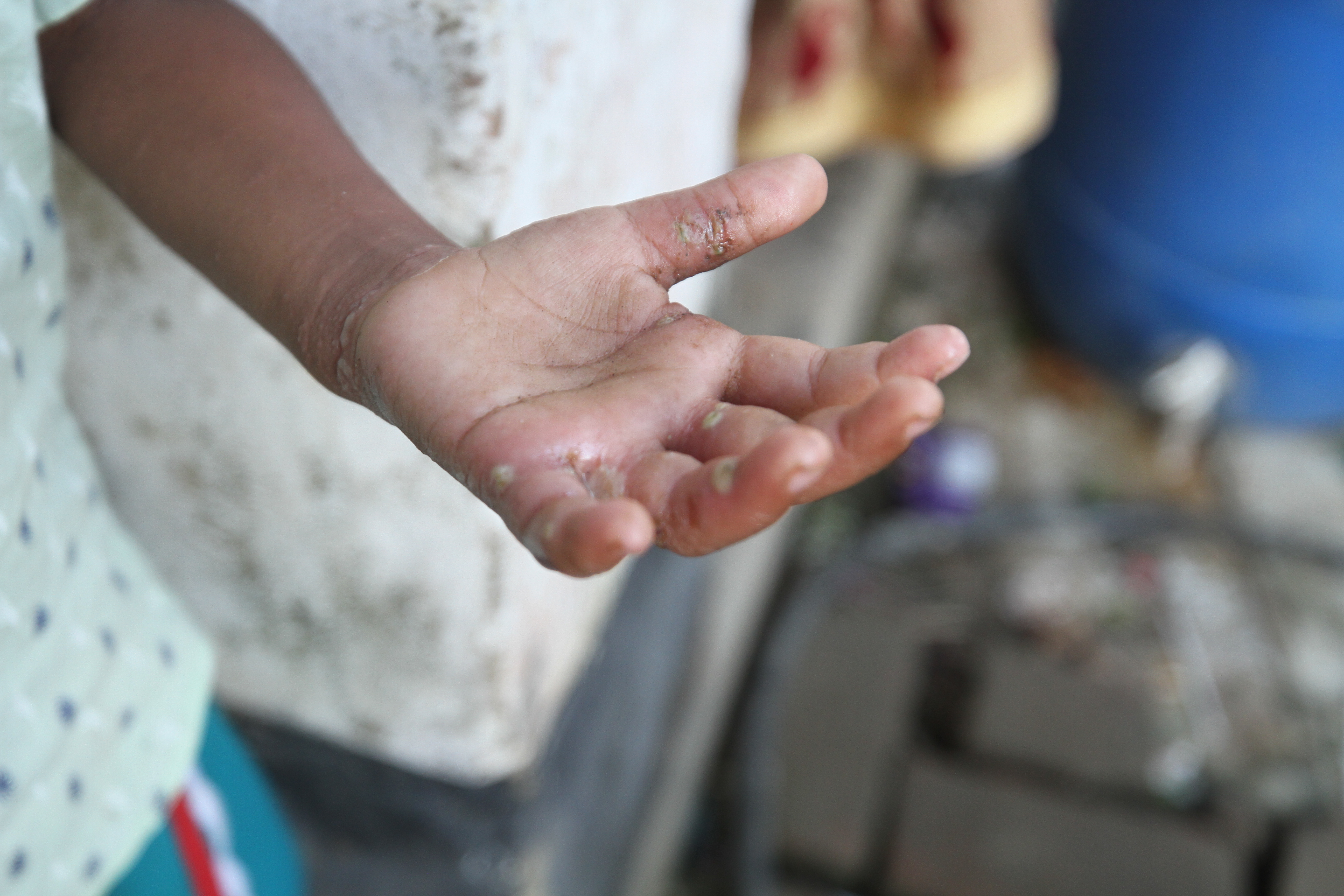 ফেনী: প্লাবিত প্রান্তরজুড়ে পানিবাহিত রোগের প্রকোপ