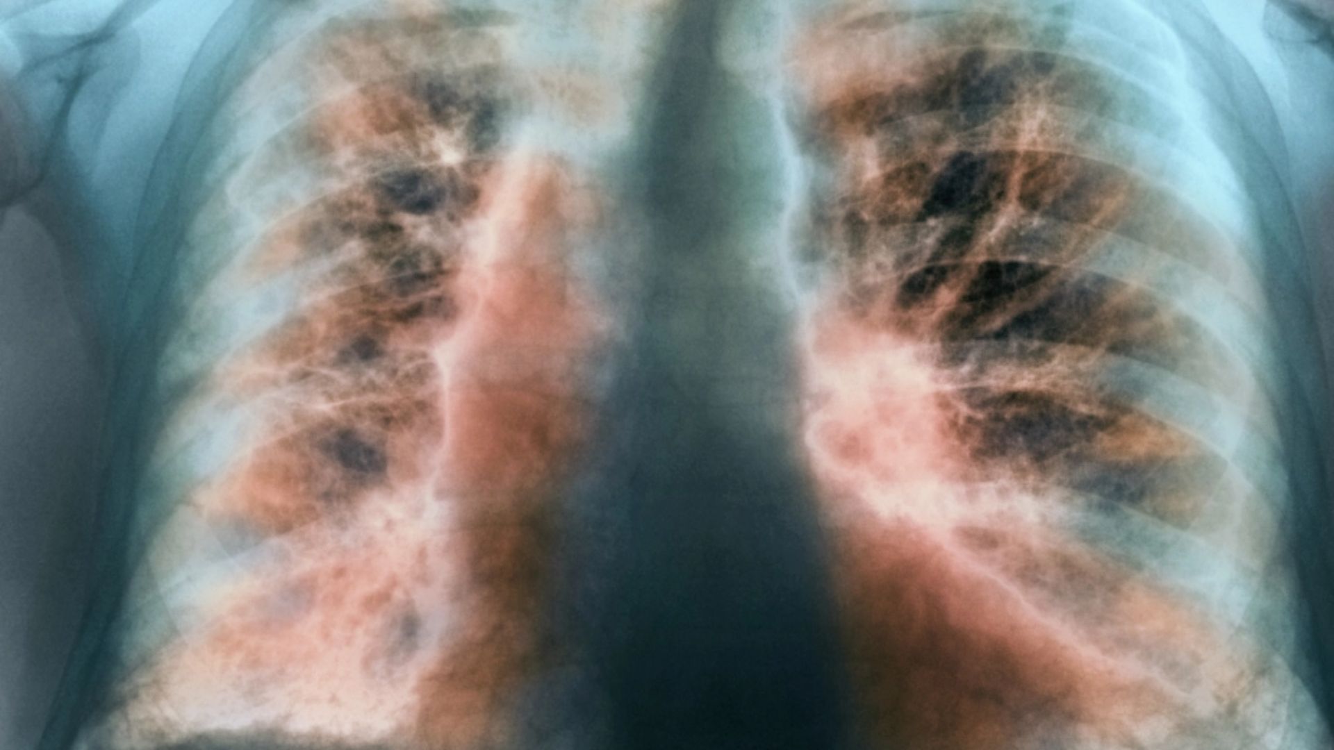 কোন রোগে ভুগছিলেন ওস্তাদ জাকির হোসেন, কেন হয়, কাদের হয়