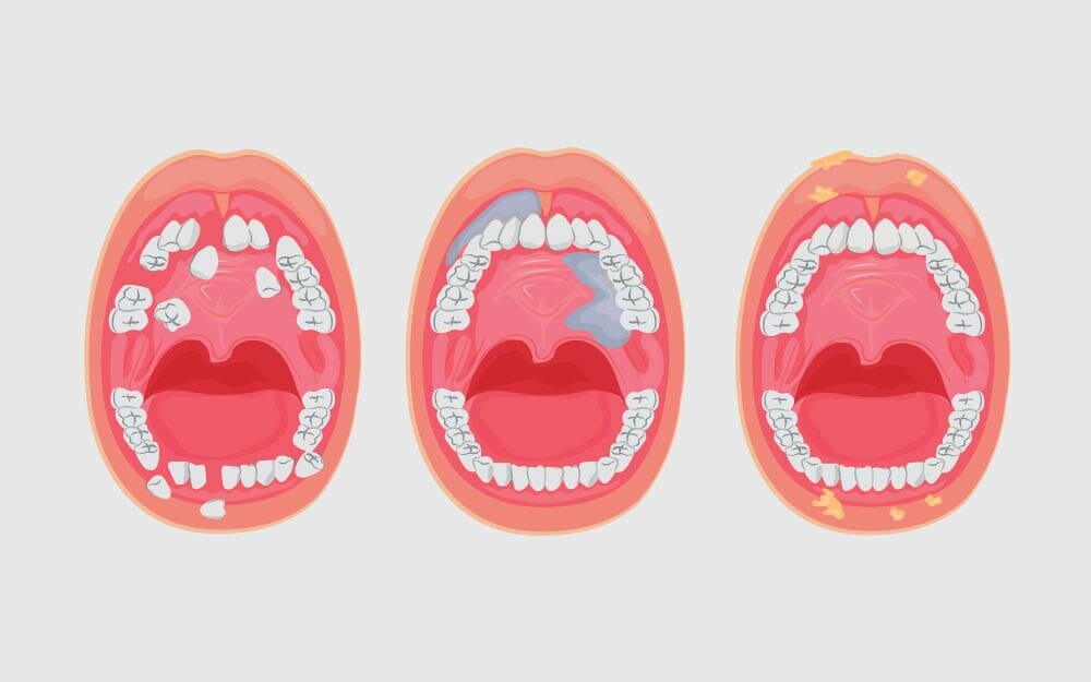 মুখ ও মুখগহ্বরের ক্যানসার কেন হয়, লক্ষণ ও শনাক্ত করার উপায়