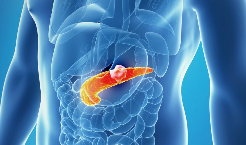 অগ্ন্যাশয়ের ক্যানসার কেন হয়, লক্ষণ ও চিকিৎসা কী