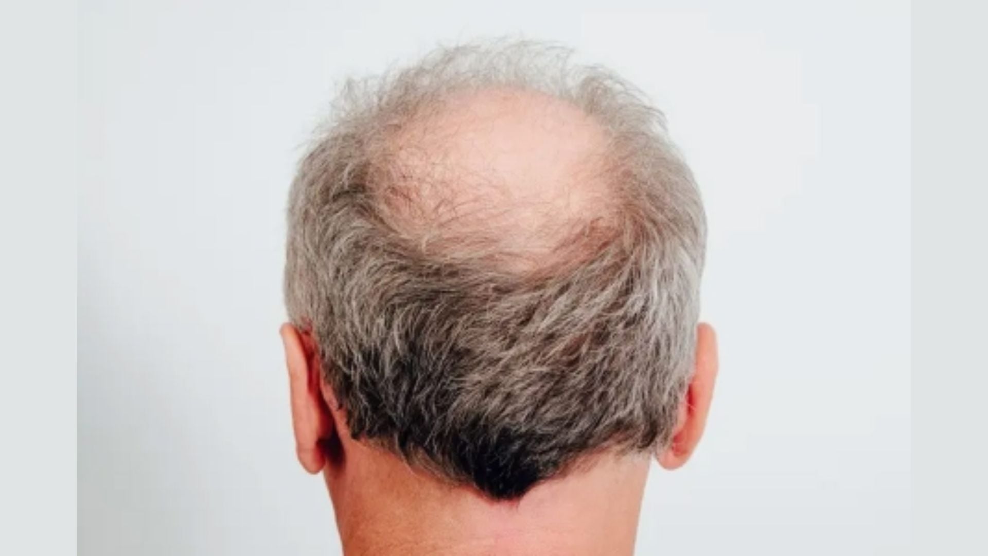 টাক মাথায় কি আসলেই চুল গজায়