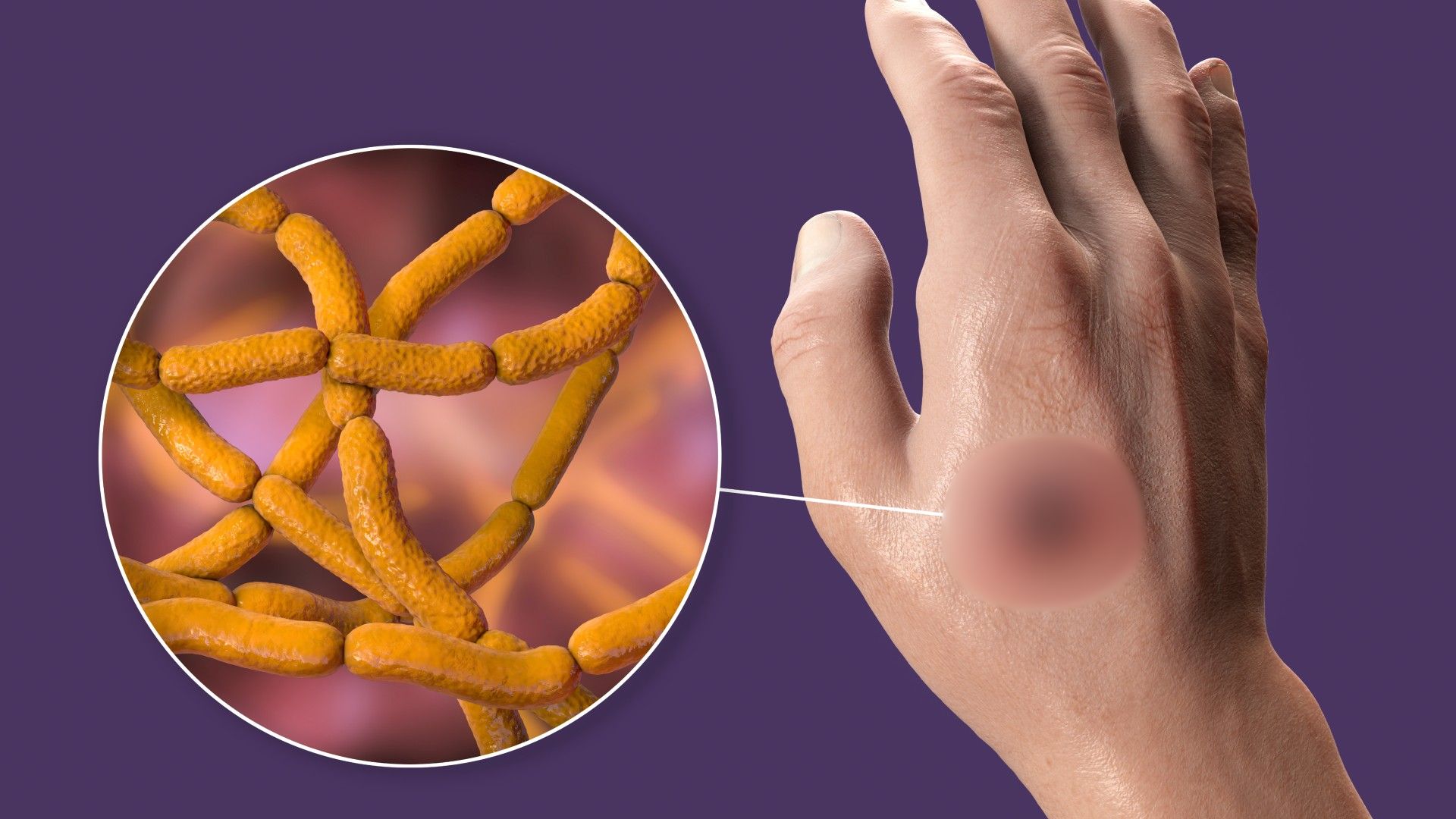 অ্যানথ্রাক্স কীভাবে ছড়ায়, প্রতিরোধে করণীয়