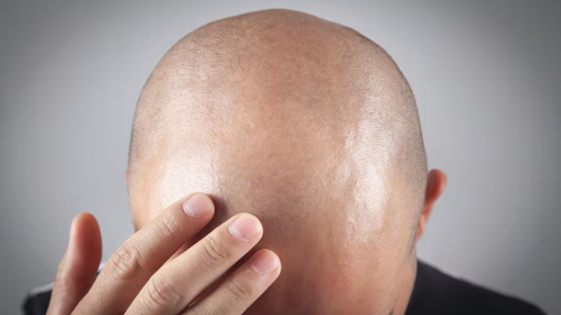 টাক মাথায় কি খুশকি হয়?