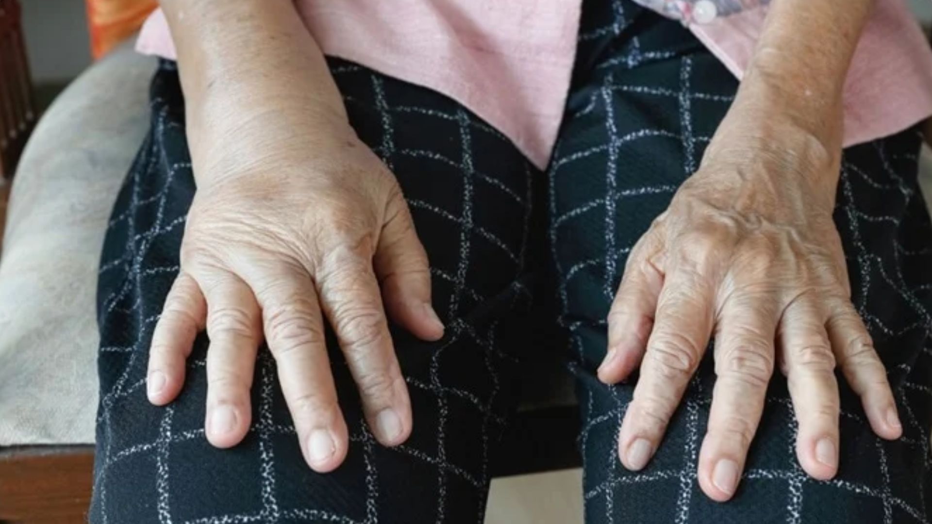 কী কী কারণে হাত-পায়ে পানি জমে, কখন চিকিৎসকের কাছে যাবেন?