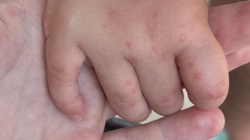 হ্যান্ড ফুট অ্যান্ড মাউথ ডিজিজ.jpeg