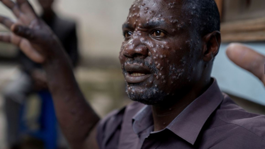 কঙ্গোর এক শরণার্থী শিবিরে এমপক্স আক্রান্ত জঁ কাকুরু বিয়ামবো (৪৮) চিকিৎসা নিচ্ছেন। ফাইল ছবি: রয়টার্স (জুলাই, ২০২৪)