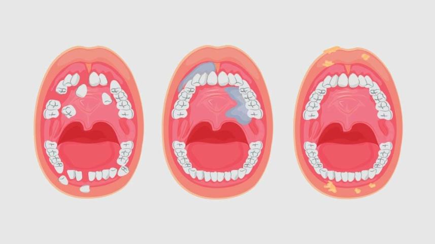 মুখের ক্যানসার