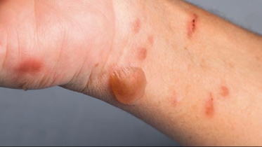 ‘টমেটো ফ্লু’ নামটি এসেছে এ রোগের মূল উপসর্গ থেকে। এ রোগে আক্রান্ত হলে দেহের বিভিন্ন অংশে টমেটো আকৃতির ফোস্কা দেখা দেয়। ছবি: সংগৃহীত