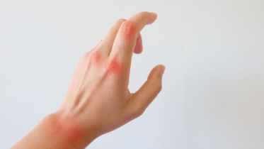 রিউমাটয়েড আর্থ্রাইটিস 