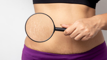 স্ট্রেচ মার্ক