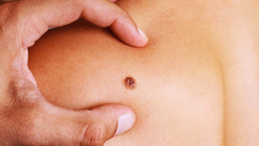 ত্বকের ক্যানসার