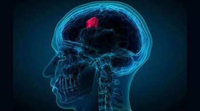 Brain Tumor